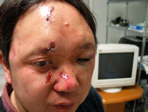 二零零六年二月八日美国法轮功学员李渊在亚特兰大家中遭持枪歹徒袭击，脸上缝了十五针
