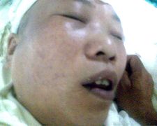 陳玉梅被惡警打昏後在醫院的照片