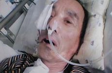 李德成被大连南关岭监狱迫害的左侧脸已萎缩，左眼塌陷失明，腿部严重受伤