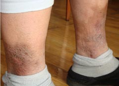 证据照片：初立文被铁夹板夹双腿后腿上伤痕