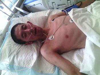 张国立在庄河中心医院重症监护室（ICU），胳膊和胸口处可以看出在看守所被殴打后的青紫