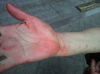 图3：右手被强行按印泥并被掐成瘀伤