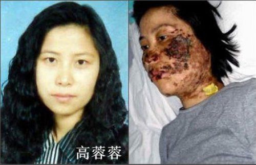 法轮功学员高蓉蓉被中共警察电击前后对比照片