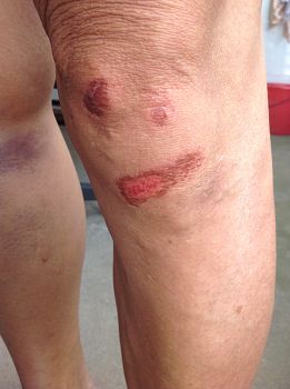 雷安祥遭警察殴打，两腿被打得红肿、青紫