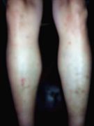 六年前双腿被酷刑折磨后留下的疤痕