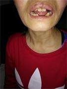 王素梅被迫害牙齿掉了四颗，还有七颗活动。