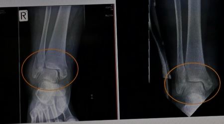 '圖2：王久春女士2015年11月7日的踝關節X光片（左）與同年12月4日的X光片（右），對比可以看出，車禍3周後骨折處已有癒合趨勢。'