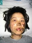 高蓉蓉二零零四年五月七日被酷刑折磨，脸上是电烧灼伤。照片是受伤十天后拍摄的。