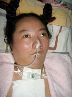 李慧琪被迫害成全身瘫痪，气管被切开，靠插管维持呼吸的照片