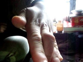 柳志梅左手中指已残疾，骨节粗大，严重弯曲变形，无法伸直。据业内人士分析，可能是柳志梅遭受长期注射毒针所致。
