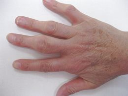 注射毒针的后遗症：胡克玲手指的骨节肿大