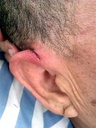 李洪奎的右侧耳部有一长3CM左右纵向豁裂伤口