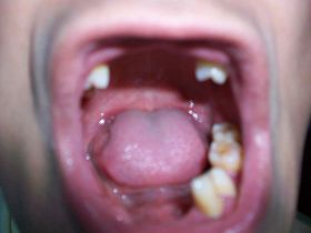 图为张惠强大部份牙脱落后的口腔。