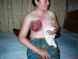 法轮功学员王云洁，她的乳房被长时间电击，致使整个乳房溃烂