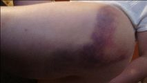 腿伤被打紫