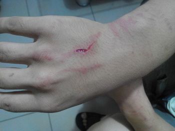 图2：李宗泽被手铐铐出的伤痕