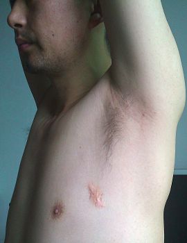 张志强2001年5月在劳教所被吊打烫伤腋窝伤疤，2015年6月手机拍照