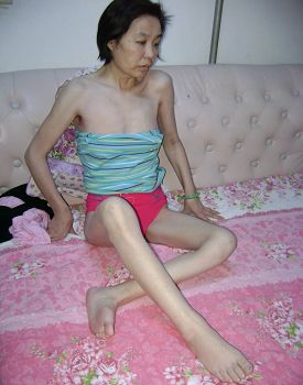 吴国辉被迫害得骨瘦如柴（上图是从监狱接回后3天拍摄的照片）