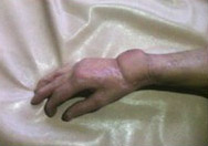 图1：一块肚皮植在手腕上