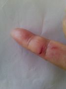 庞继红被割开的手指伤口