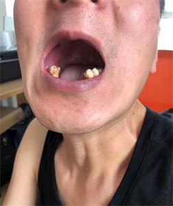 '刘宏伟被迫害得仅剩下颚的几颗牙齿'