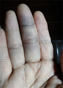 图1：王晓玲右手中指淤伤