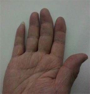 '图2：王晓玲右手手指变形'