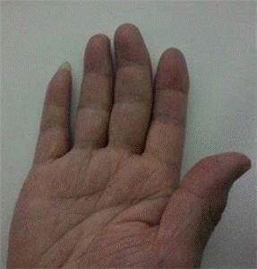 '图2：王晓玲右手手指变形'